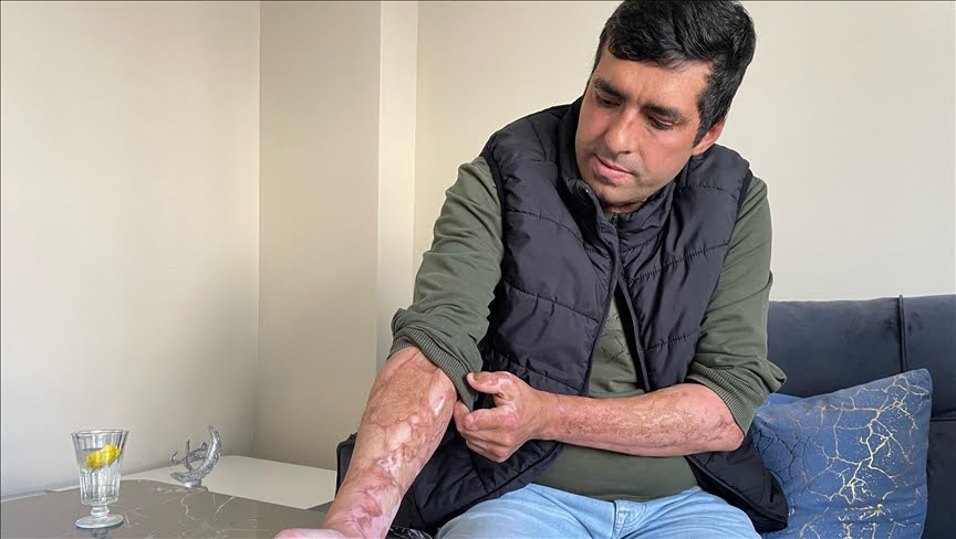 Bartın’da maden ocağındaki patlamadan yaralı kurtulan işçiler, arkadaşlarını unutamıyor