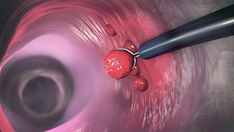 Yutkunma şikayetiyle gittiği hastanede bağırsağında polip çıktı