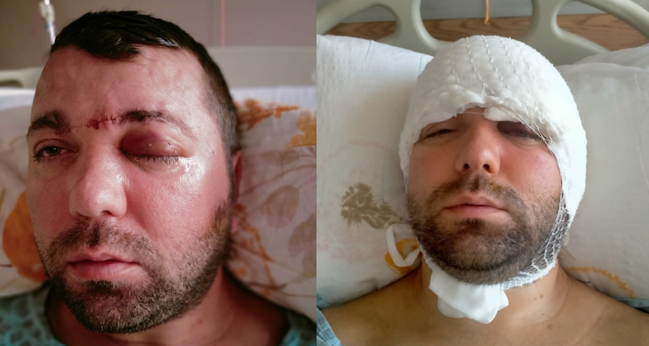 İmplant tedavisinde vida beynine saplandı