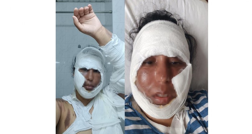 Yüzüne Kaynar Su Döktü