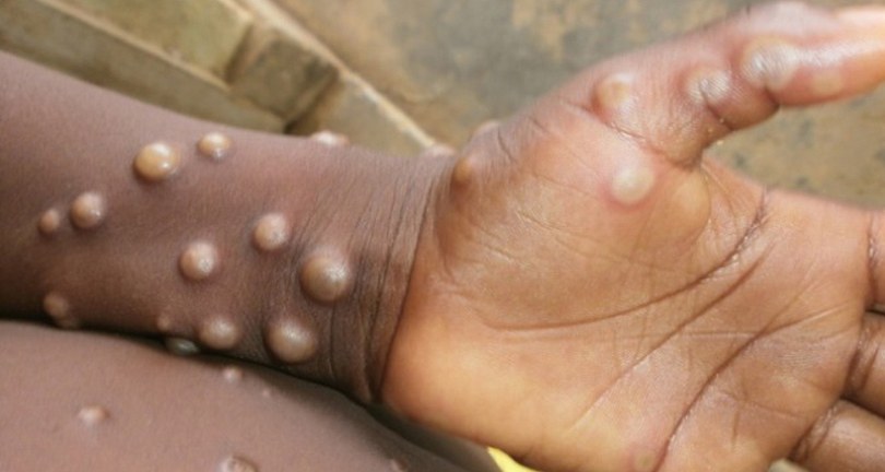 Maymun çiçeği virüsü İsveç’e sıçradı