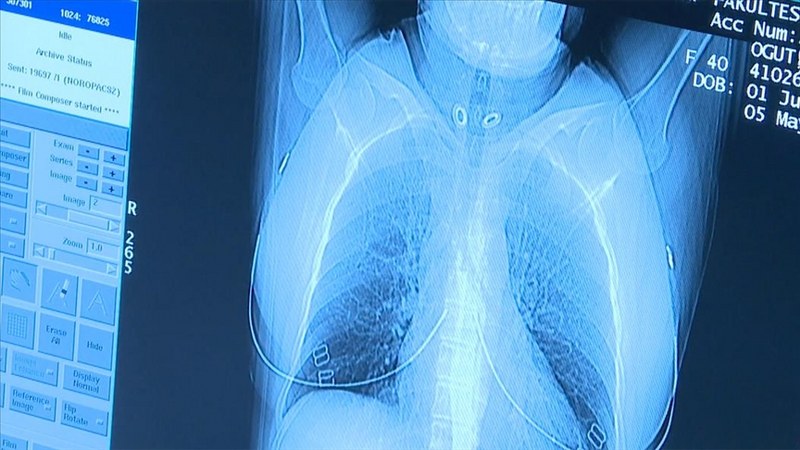 Akciğer kanserinde erken teşhis mümkün