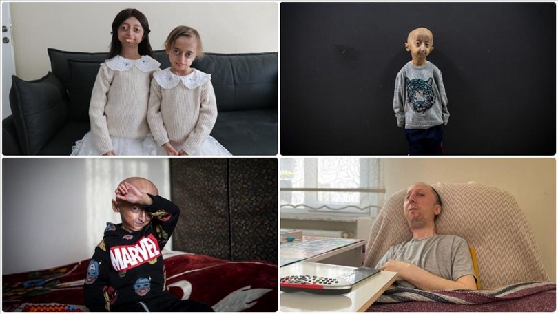 Dünya Genelinde 7 Bin Nadir Hastalık 400 Milyon Kişiyi Etkiliyor