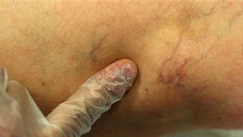 Varis tedavisinde yenilikçi lazer yöntemiyle hasta kısa sürede ayağa kalkıyor