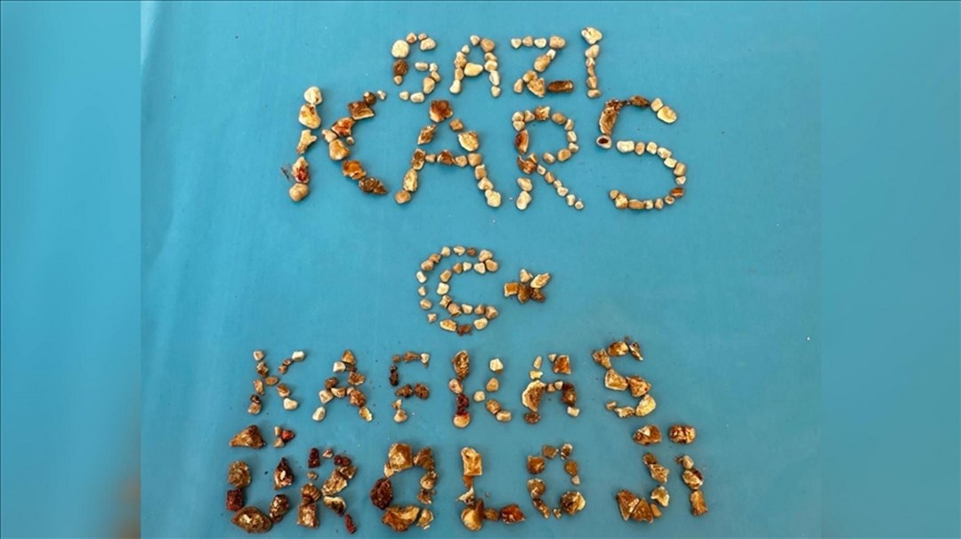 Hastanın iki böbreğinden 300’ün üzerinde taş çıktı