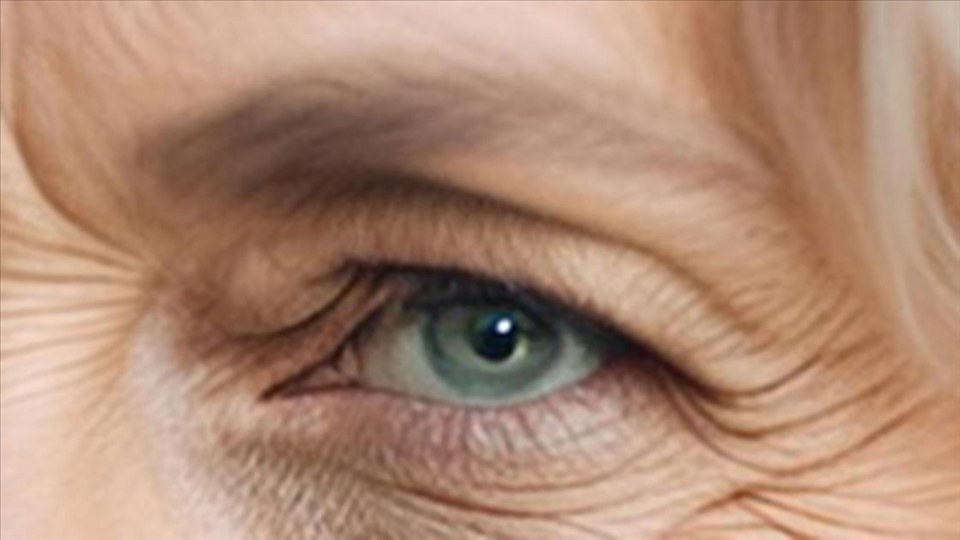 Prof. Dr. Yeniad’tan göz kapağı düşüklüğünde cerrahi tedavi uyarısı