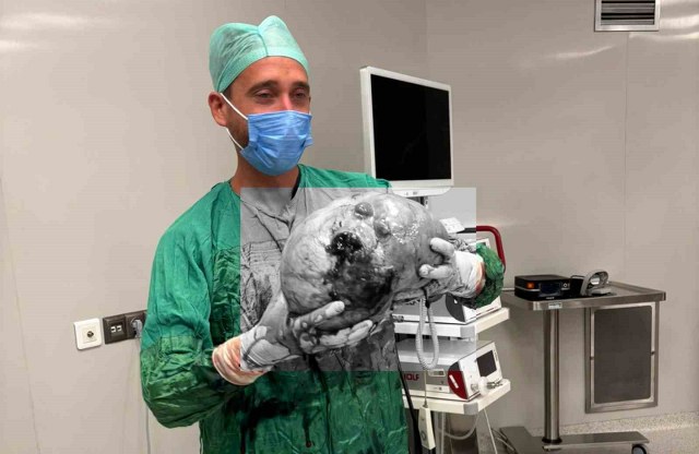 Yozgat’ta bir hastadan karpuz büyüklüğünde kitle çıkartıldı