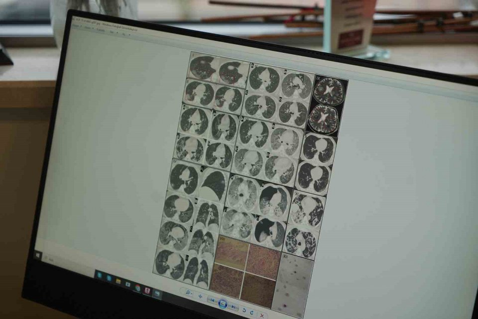 Gençlerde ani ölümler artıyor: “Nedeni ise virüsün damarlarda bıraktığı hasar”