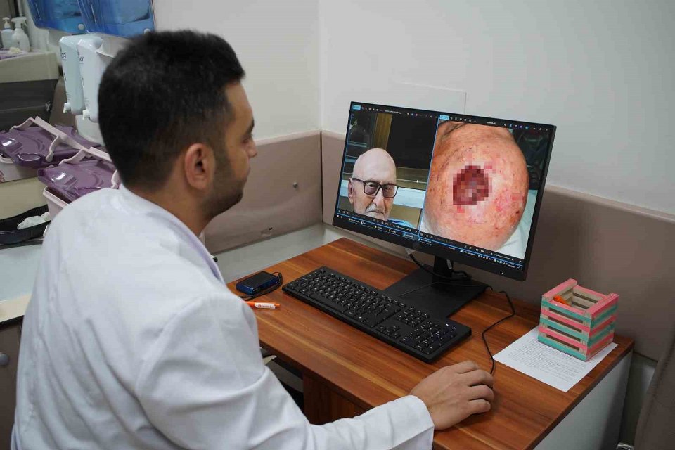 Dünyada 3’üncü kez rastlandı: Saçlı derideki nadir tümör Sakarya’da tedavi edildi