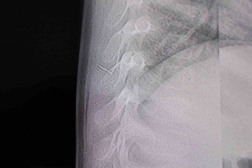 Bebeğin sırtından tel parçası çıktı