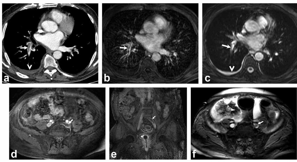 Akciğer damarındaki pıhtıların tanısında radyasyonsuz çözüm