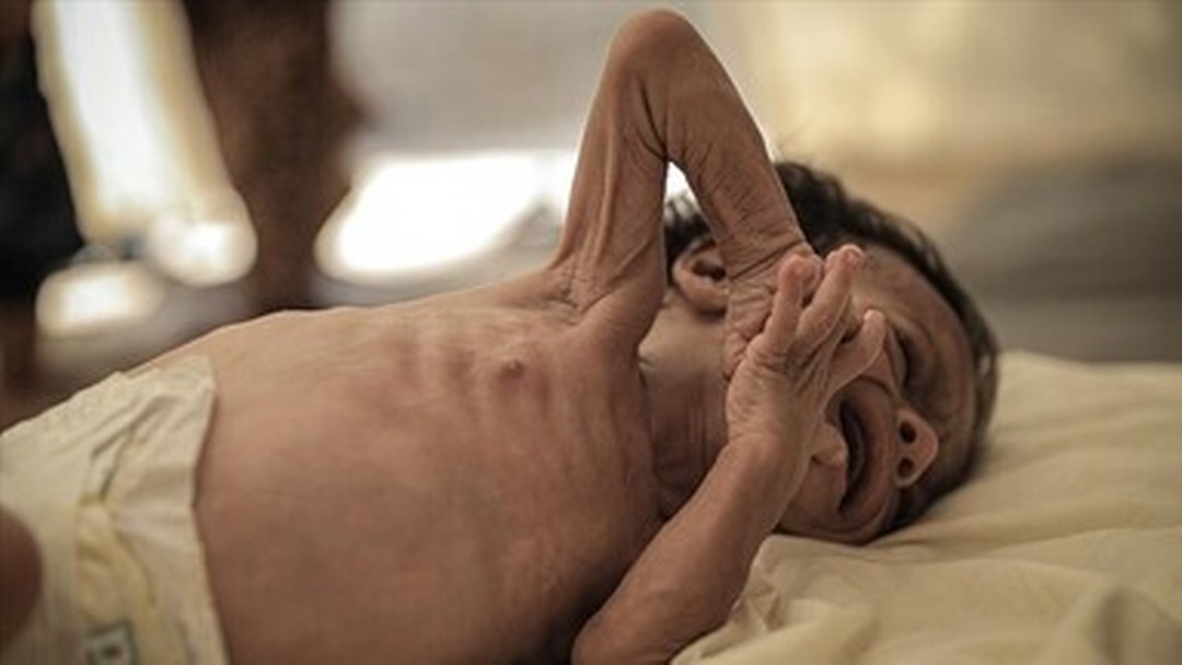 Bangladeş’te 15 Mart’tan bu yana kızamık olduğu doğrulanan veya belirtileri görülen 528 çocuk öldü
